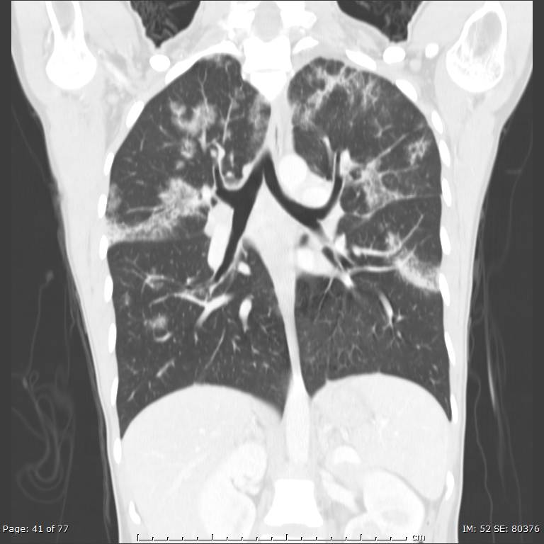 Acute eosinophilic pneumonia (Radiopaedia 48211-53073 Coronal lung window 27).jpg