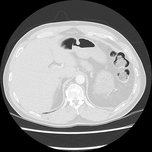 Acute epicardial fat necrosis (Radiopaedia 42327-45440 Axial lung window 53).jpg
