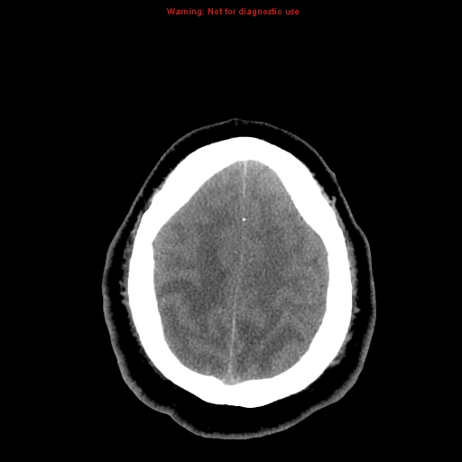 Acute hemorrhagic leukoencephalitis (Radiopaedia 14076-13920 Axial non-contrast 42).jpg