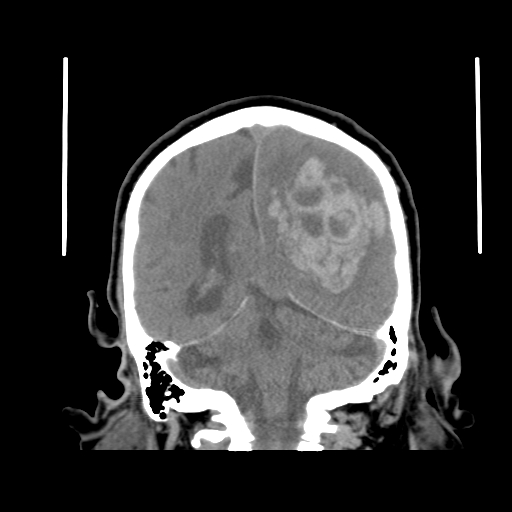 Acute hemorrhagic stroke (Radiopaedia 17507-17223 Coronal non-contrast 36).jpg