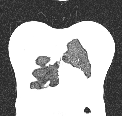 Acute hypersensitivity pneumonitis (Radiopaedia 85293-100870 Coronal lung window 5).jpg