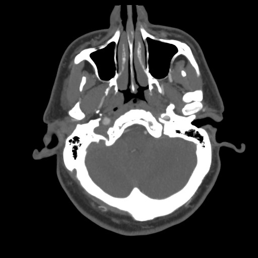 File:Acute internal carotid artery dissection (Radiopaedia 53541-59630 D 14).jpg