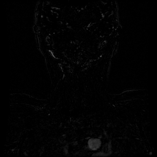 Acute internal carotid artery dissection (Radiopaedia 53541-59632 Coronal MRA 4).jpg