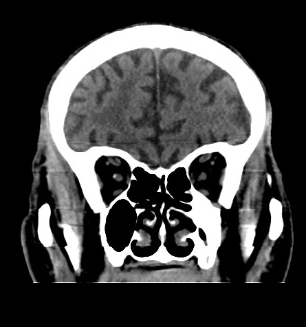 Acute left anterior cerebral artery territory infarction (Radiopaedia 51785-57578 Coronal non-contrast 15).jpg