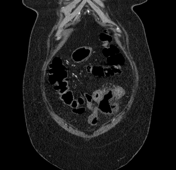 Acute mesenteric ischemia (Radiopaedia 80029-93316 Coronal C+ arterial phase 15).jpg