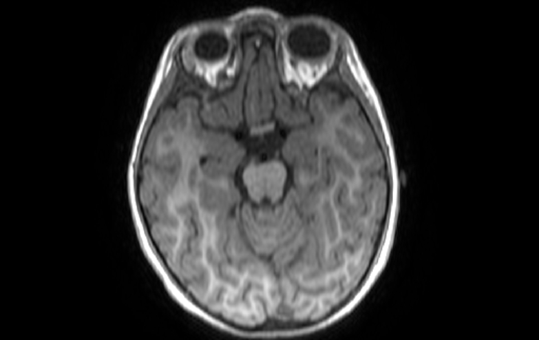 File:Acute necrotizing encephalitis of childhood (Radiopaedia 67356-76737 Axial T1 62).jpg