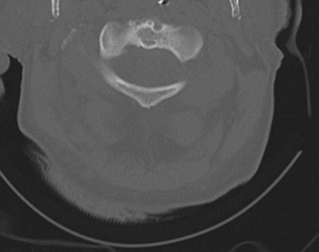 Acute on chronic subdural hematoma and thoracic vertebral injury in a multitrauma patient (Radiopaedia 31698-32619 Axial bone window 16).jpg