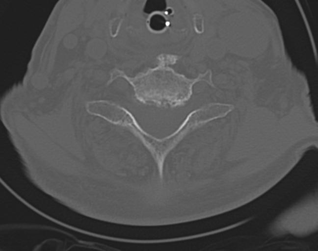 Acute on chronic subdural hematoma and thoracic vertebral injury in a multitrauma patient (Radiopaedia 31698-32619 Axial bone window 42).jpg