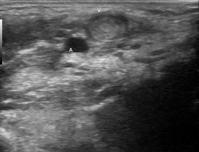 File:Acute osteomyelitis - humerus (Radiopaedia 22138-22152 Transverse 1).jpg