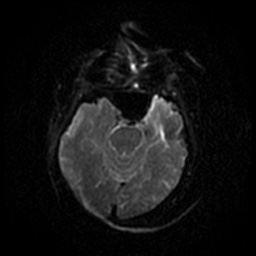 Acute otitis externa (Radiopaedia 57296-64236 Axial DWI 33).jpg