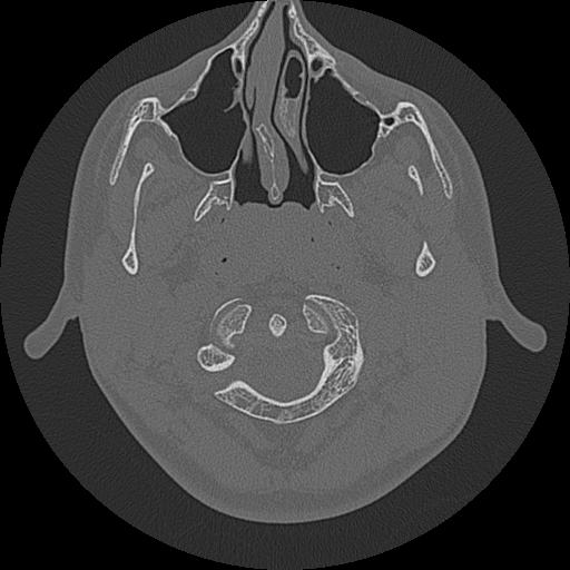 Acute otomastoiditis and Bezold abscess (Radiopaedia 88184-104786 Axial bone window 5).jpg