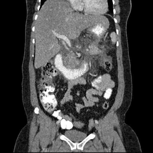File:Acute pancreatitis (Radiopaedia 20829-20744 Coronal C+ portal venous phase 26).jpg