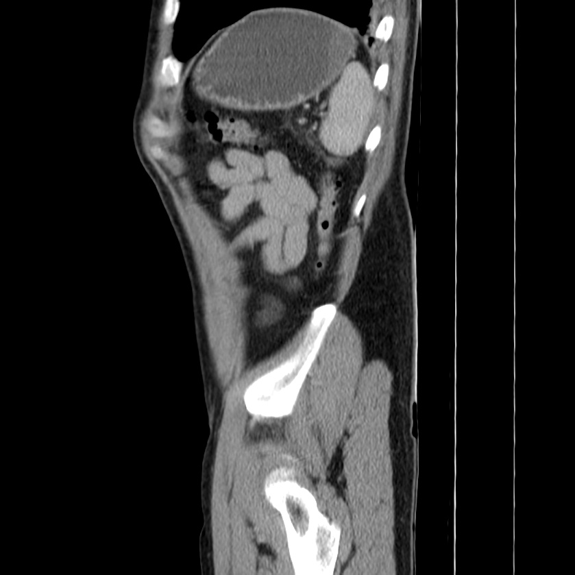 Acute pancreatitis (Radiopaedia 22572-22596 Sagittal C+ portal venous phase 47).jpg