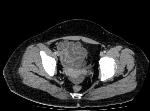 Acute pancreatitis (Radiopaedia 69236-79012 Axial C+ portal venous phase 82).jpg