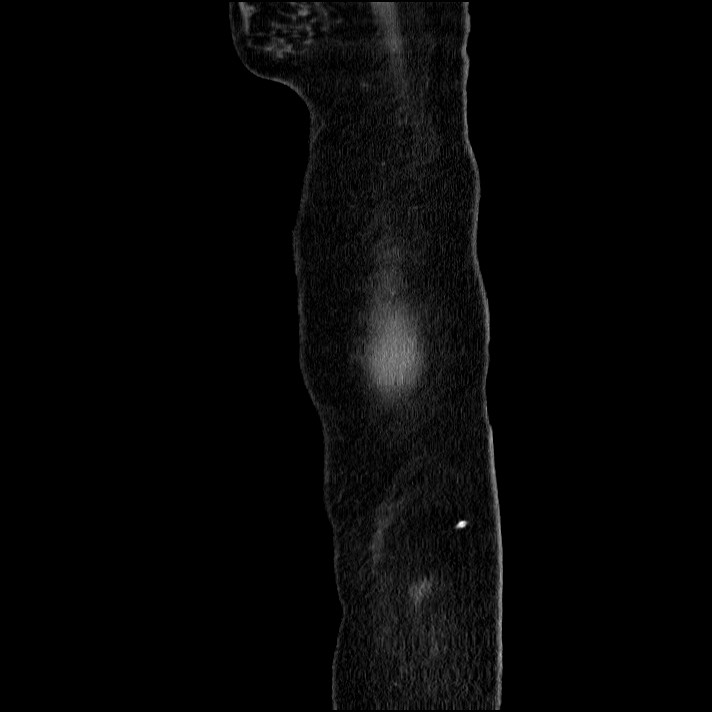 Acute pancreatitis (Radiopaedia 69236-79012 Sagittal C+ portal venous phase 92).jpg