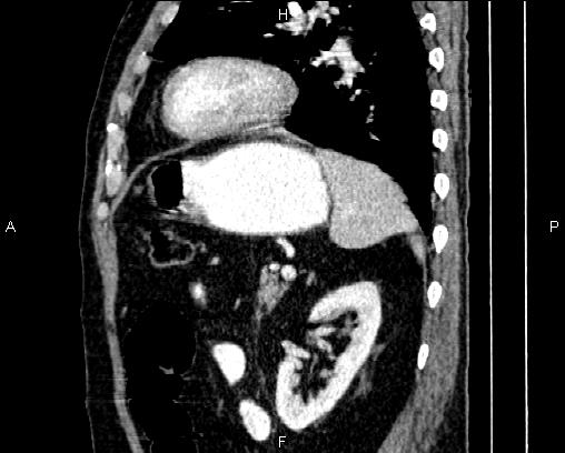 Acute pancreatitis (Radiopaedia 85146-100701 Sagittal C+ portal venous phase 69).jpg