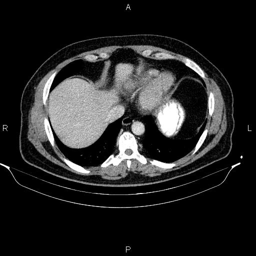 File:Acute pancreatitis (Radiopaedia 85390-101010 Axial C+ portal venous phase 11).jpg