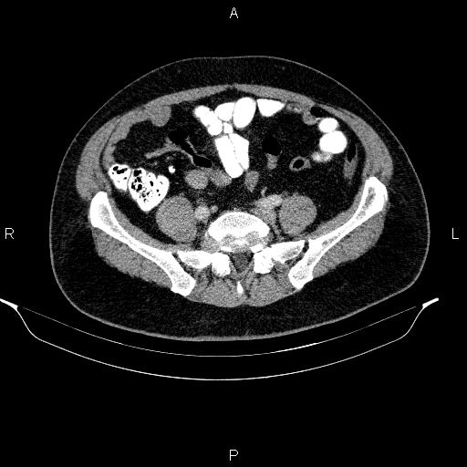Acute pancreatitis (Radiopaedia 85390-101010 Axial C+ portal venous phase 78).jpg