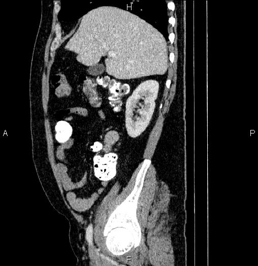 Acute pancreatitis (Radiopaedia 85390-101010 Sagittal C+ portal venous phase 25).jpg