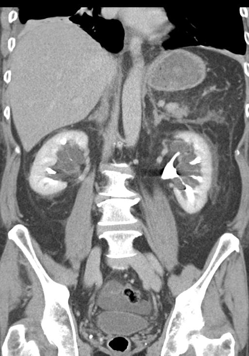 Acute pancreatitis and walled-off necrosis (Radiopaedia 29888-30403 E 35).jpg