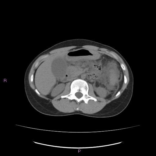 Acute pancreatitis secondary to stone at minor papilla and pancreatic divisum (Radiopaedia 76570-88333 Axial non-contrast 31).jpg
