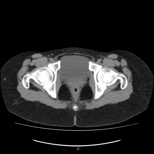 File:Acute pancreatitis secondary to stone at minor papilla and pancreatic divisum (Radiopaedia 76570-88333 Axial non-contrast 77).jpg
