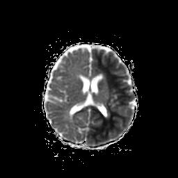 File:Acute phase of hemiconvulsion-hemiplegia epilepsy syndrome (Radiopaedia 29309-29745 Axial ADC 10).jpg