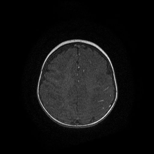 Acute phase of hemiconvulsion-hemiplegia epilepsy syndrome (Radiopaedia 29309-29745 Axial TOF angiography 5).jpg