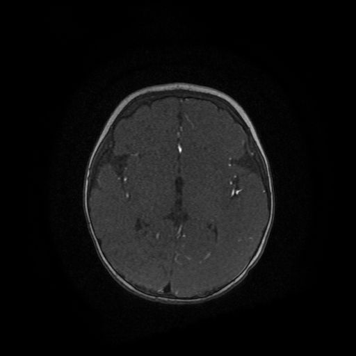 Acute phase of hemiconvulsion-hemiplegia epilepsy syndrome (Radiopaedia 29309-29745 Axial TOF angiography 54).jpg