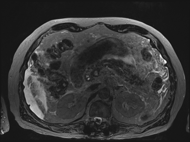 Acute portal vein thrombosis (Radiopaedia 73198-83925 Axial Heavily T2 thin cuts 38).jpg