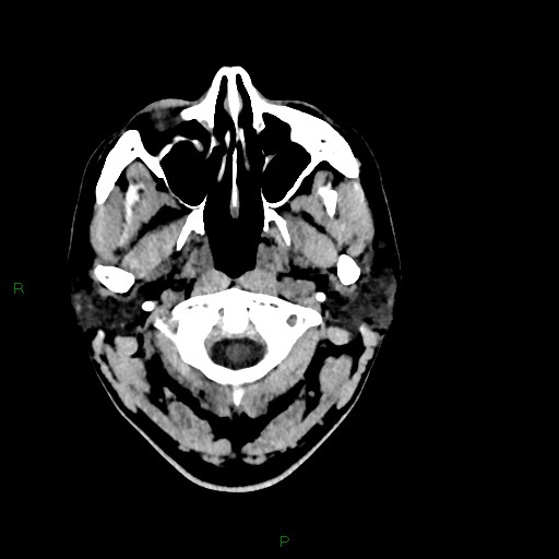 Acute posterior cerebral artery territory infarct (Radiopaedia 79329-92393 Axial non-contrast 2).jpg