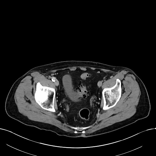 Acute renal infarction (Radiopaedia 59375-66736 Axial C+ portal venous phase 103).jpg
