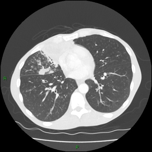 Acute right lung abscess (Radiopaedia 34806-36258 Axial lung window 117).jpg