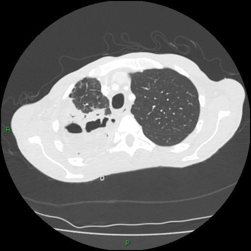 Acute right lung abscess (Radiopaedia 34806-36258 Axial lung window 39).jpg