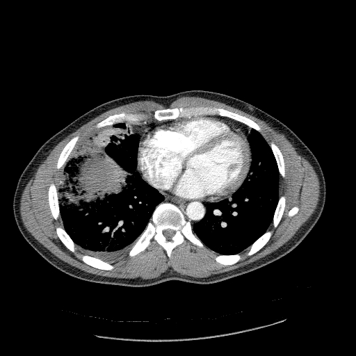 Acute segmental pulmonary emboli and pulmonary infarction (Radiopaedia 62264-70444 Axial C+ CTPA 75).jpg