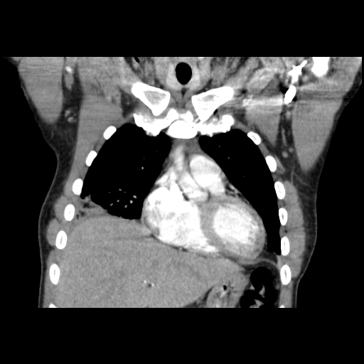 Acute segmental pulmonary emboli and pulmonary infarction (Radiopaedia 62264-70444 Coronal C+ CTPA 12).jpg
