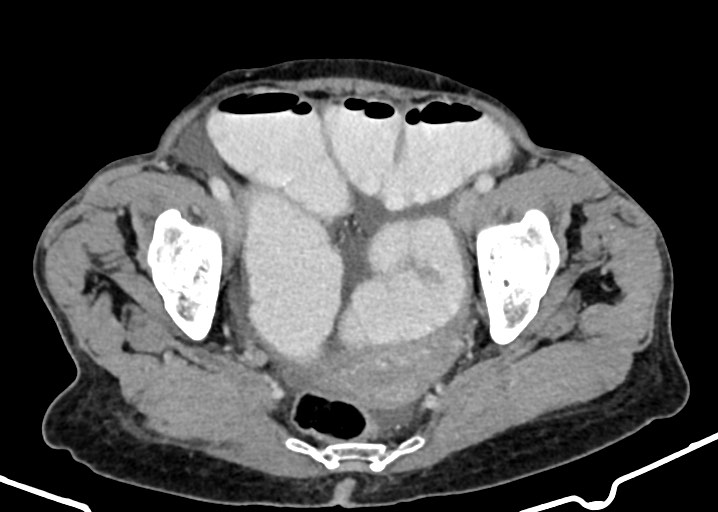 Acute small bowel (ileal) volvulus (Radiopaedia 71740-82139 Axial C+ portal venous phase 173).jpg