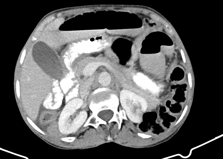 Acute small bowel (ileal) volvulus (Radiopaedia 71740-82139 Axial C+ portal venous phase 73).jpg