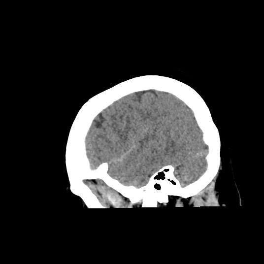 Acute subarachnoid hemorrhage and accessory anterior cerebral artery (Radiopaedia 69231-79008 Sagittal non-contrast 13).jpg