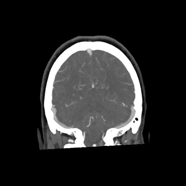 Acute subarachnoid hemorrhage and accessory anterior cerebral artery (Radiopaedia 69231-79009 Coronal C+ arterial phase 62).jpg
