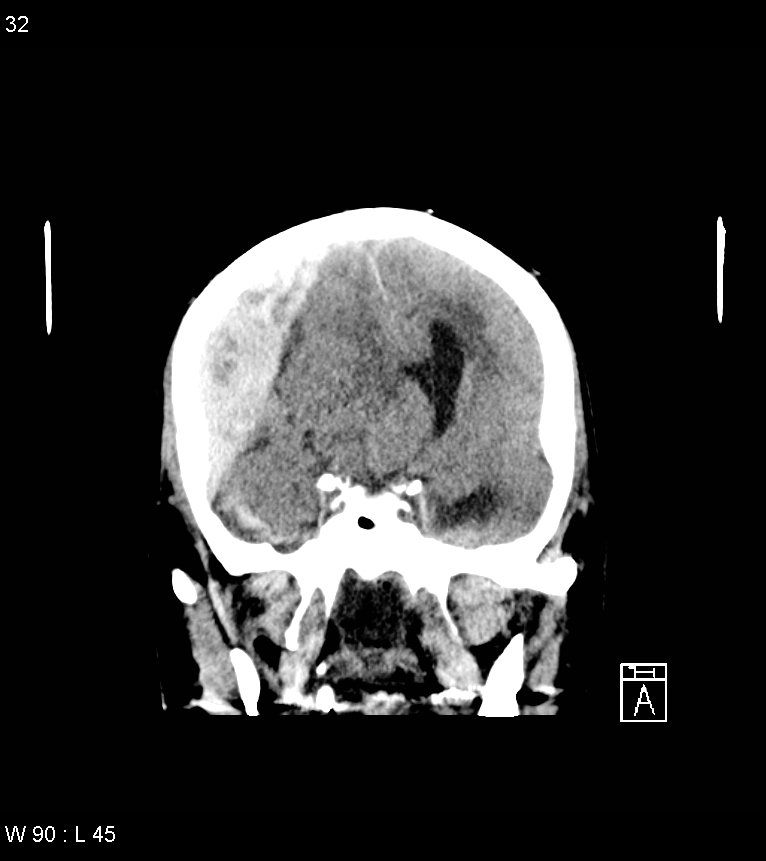 Acute subdural hematoma with myelofibrosis (Radiopaedia 52582-58494 Coronal non-contrast 23).jpg