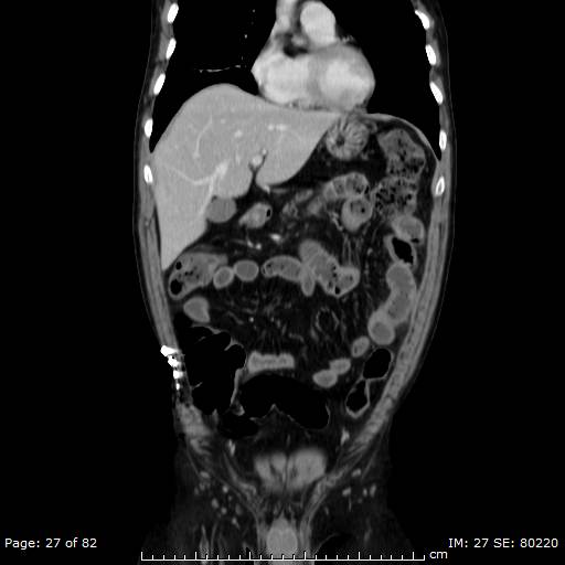 Acute superior mesenteric artery occlusion (Radiopaedia 43636-47060 Coronal C+ portal venous phase 12).jpg