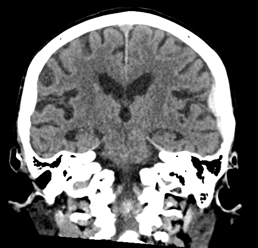 File:Acute traumatic subdural hematoma (Radiopaedia 82921-97257 Coronal non-contrast 51).jpg