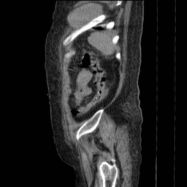 Acute tubular necrosis (Radiopaedia 28077-28334 Sagittal non-contrast 75).jpg