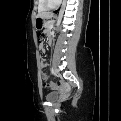 File:Acute uncomplicated appendicitis (Radiopaedia 73704-84499 Sagittal C+ portal venous phase 125).jpg