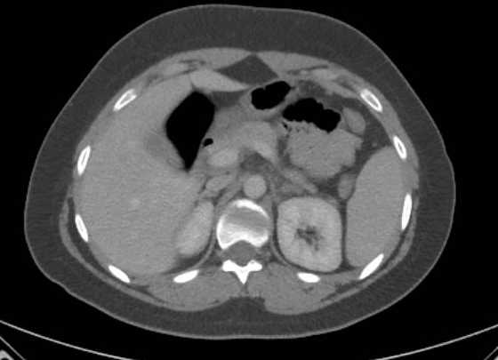 File:Acute unilateral nonhemorrhagic adrenal infarction (Radiopaedia 67560-76957 Axial renal parenchymal phase 41).jpg