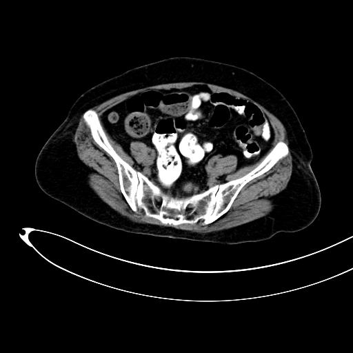 Adenocarcinoma colon with intussusception (Radiopaedia 86006-101922 Axial non-contrast 45).jpg