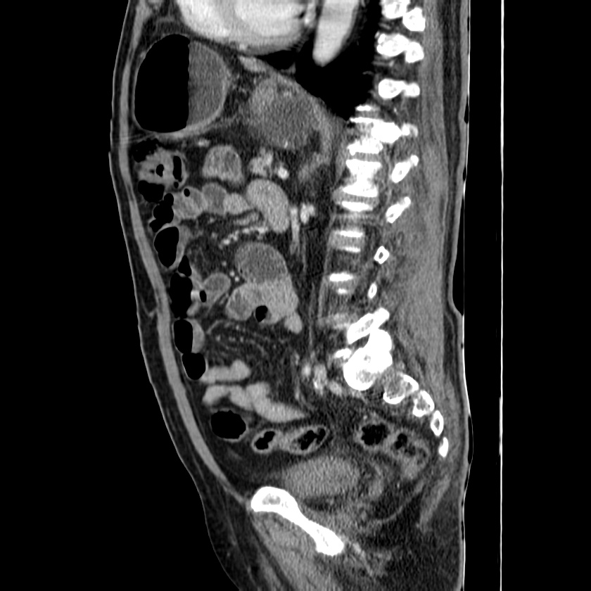 Adenocarcinoma of colon with entero-colic fistula (Radiopaedia 22832-22852 Sagittal C+ portal venous phase 39).jpg