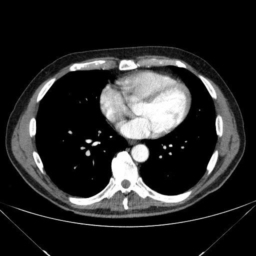 File:Adenocarcinoma of the lung (Radiopaedia 59871-67325 Axial C+ arterial phase 60).jpg