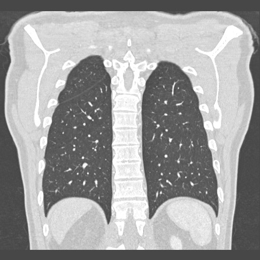 Adenocarcinoma of the lung (Radiopaedia 59871-67325 Coronal lung window 51).jpg